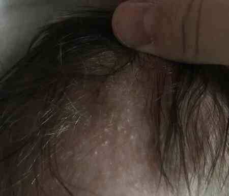 Висипання на голові у немовляти