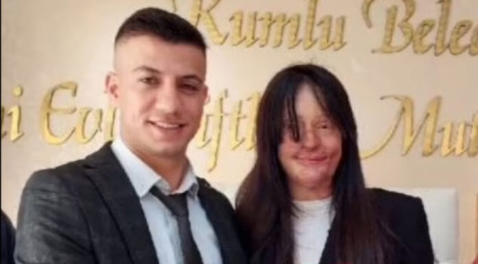 Від ненависті до любові: туркеня вийшла заміж за хлопця, який облив її кислотою