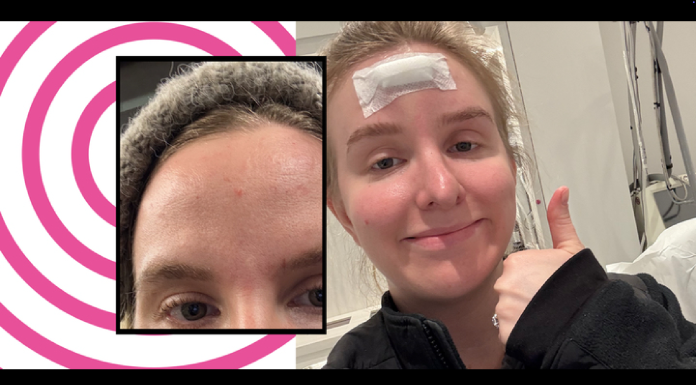 Красное угревое пятно на лбу оказалось редкой формой рака кожи